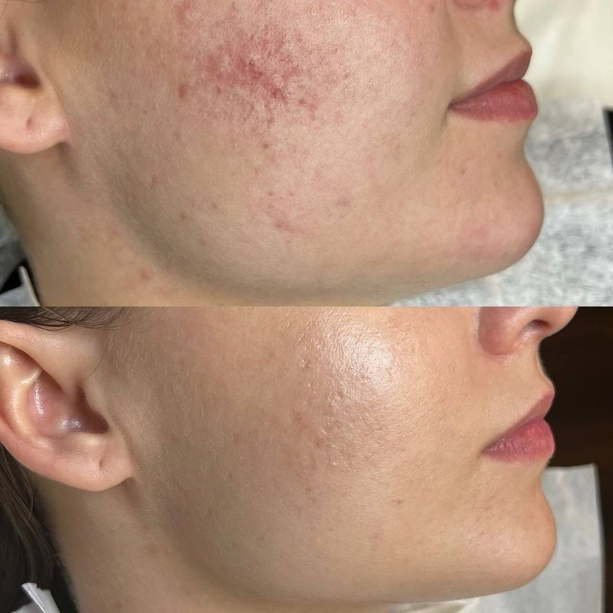 Before and after acne scar treatment at EliteMD Aesthetics — Smoother texture & calmer skin