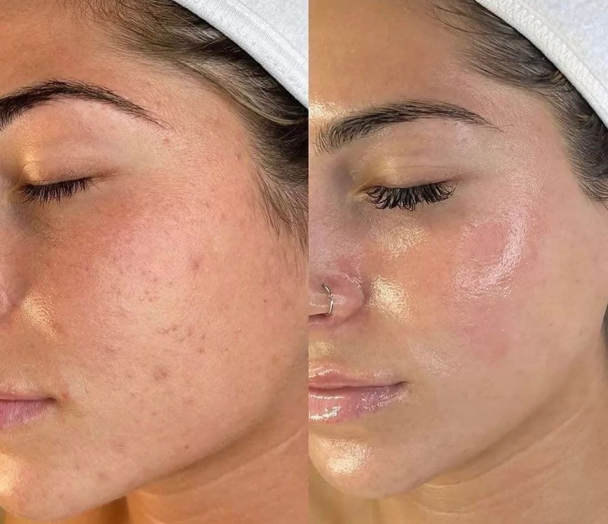 Before and after acne scar treatment results at EliteMD Aesthetics in Markham