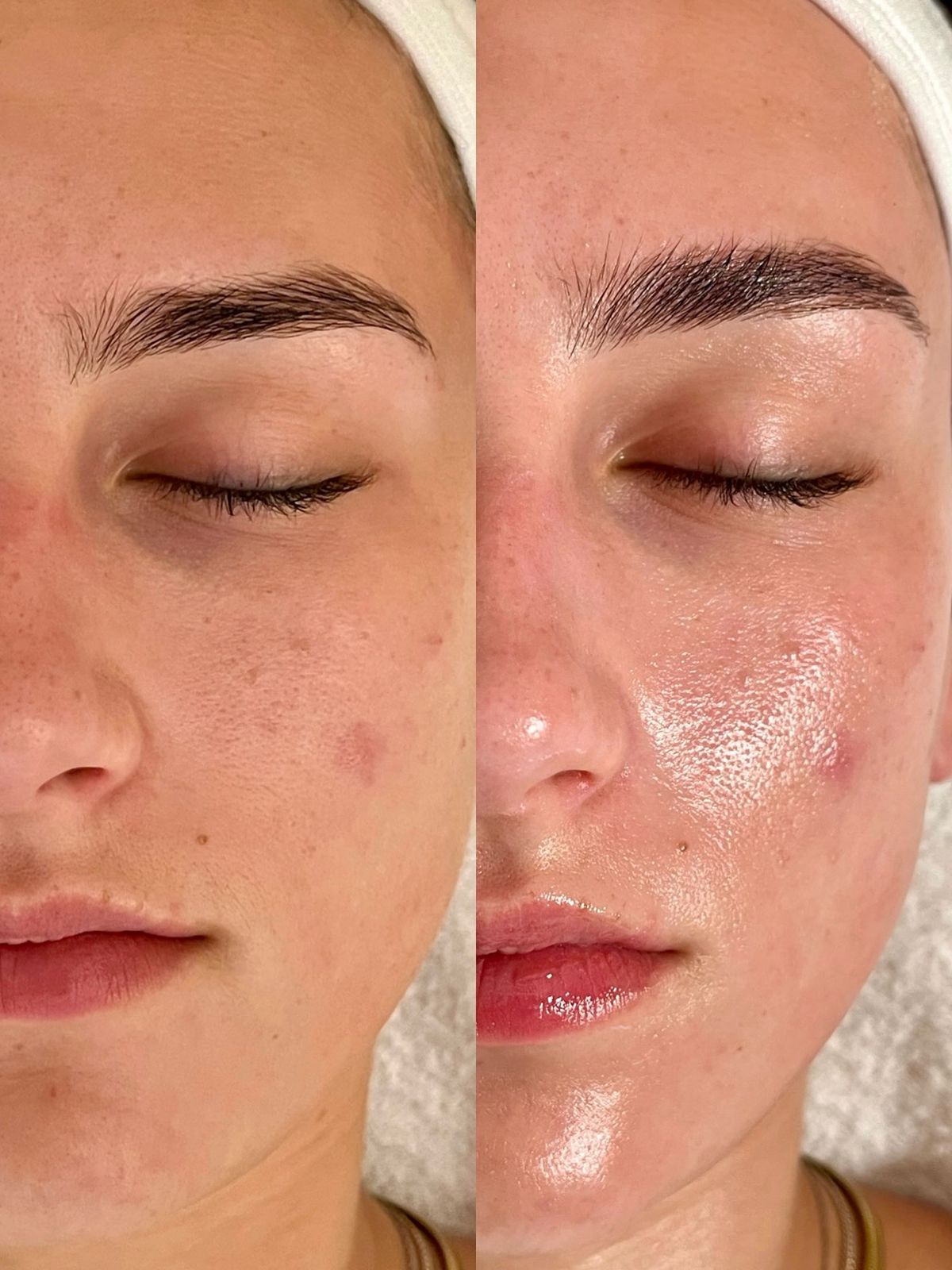 Before and after acne scar treatment at EliteMD Aesthetics — Refined pores & clarity