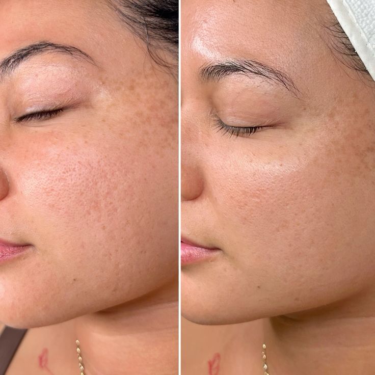 Before and after acne scar treatment at EliteMD Aesthetics — Fading post-acne marks