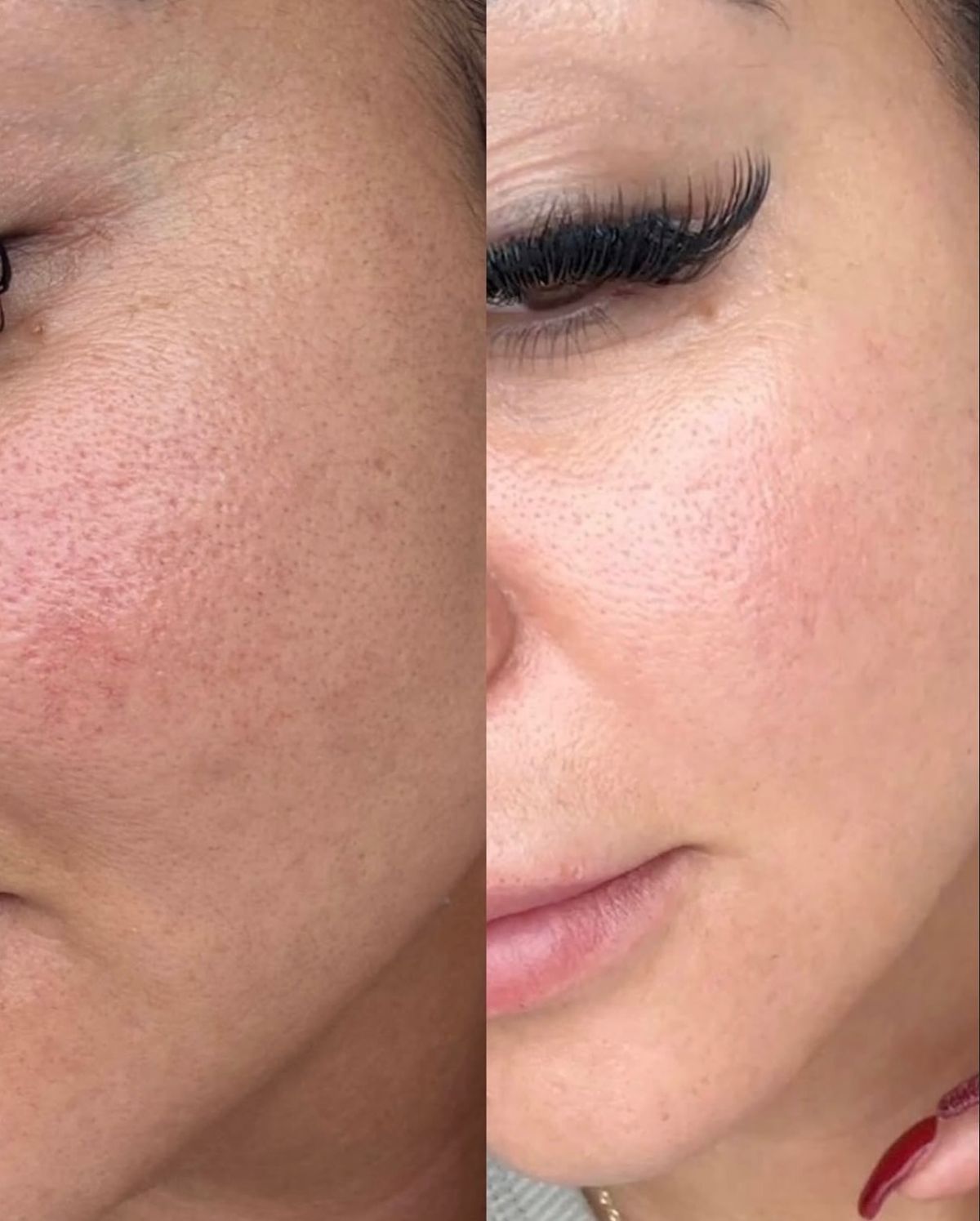 Before and after acne scar treatment at EliteMD Aesthetics — Even tone & smoother surface