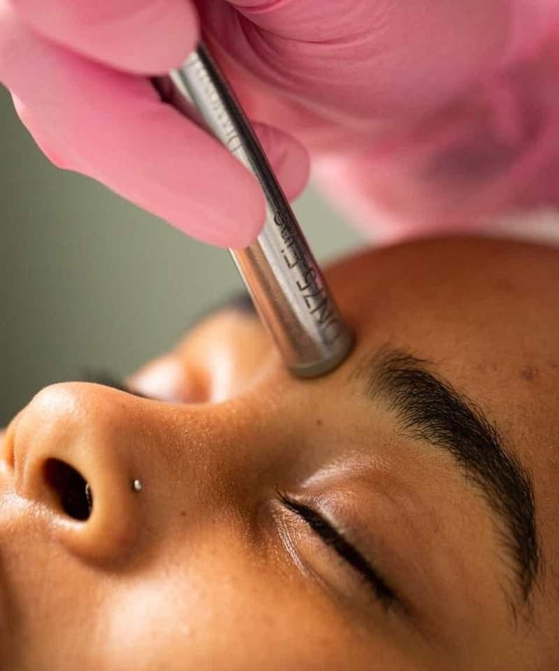 DP4 microneedling pen treatment on a client's forehead at EliteMD Aesthetics in Markham