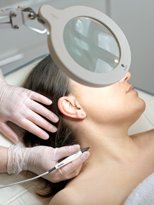Electrocautery removal under magnification at EliteMD