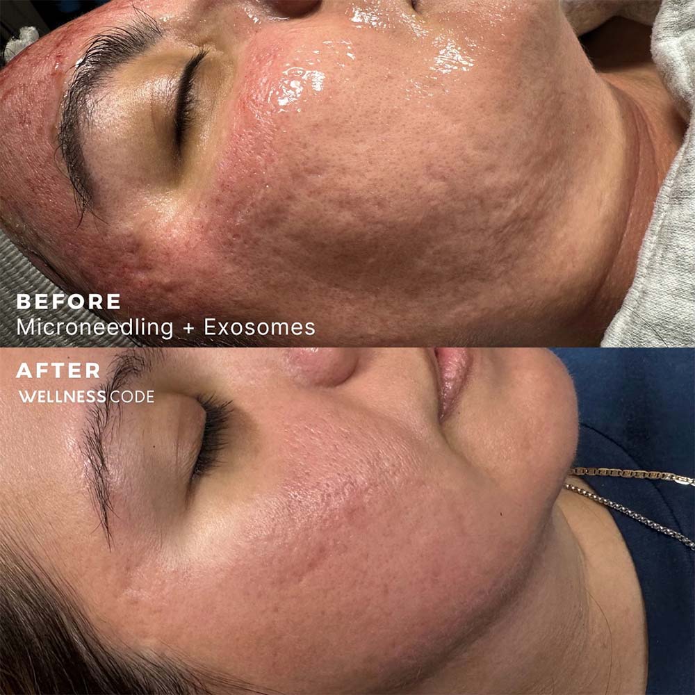 Before and after microneedling with exosomes at EliteMD
