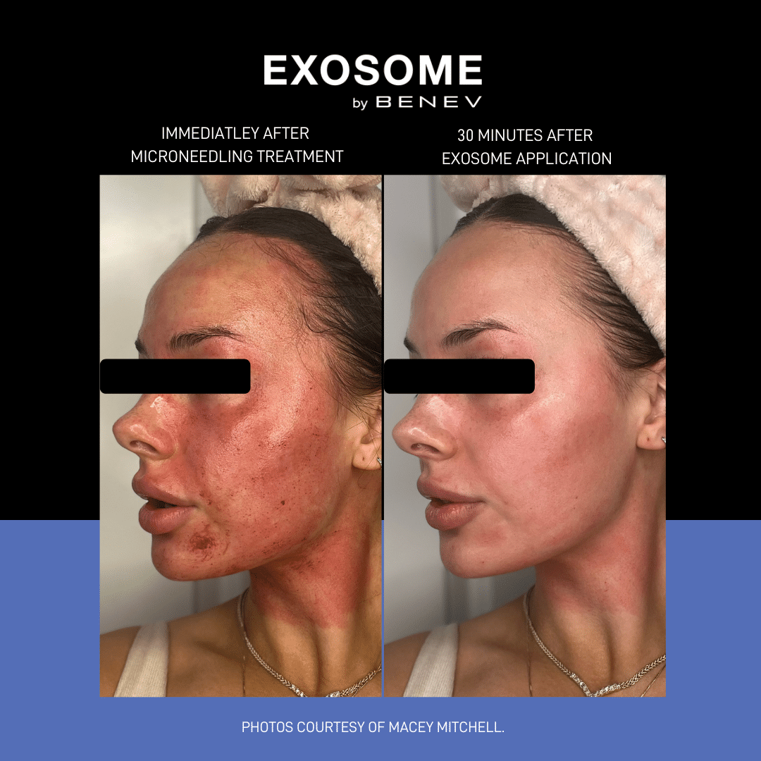Exosome and mesotherapy regenerative treatment results at EliteMD Aesthetics in Markham