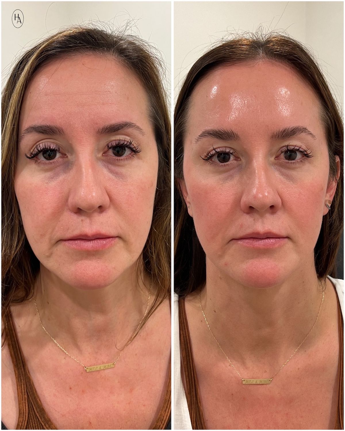 Before and after hyperpigmentation treatment at EliteMD Aesthetics — Brighter, more even complexion
