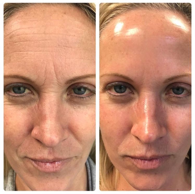 Before and after hyperpigmentation treatment at EliteMD Aesthetics — Spots faded, skin refreshed
