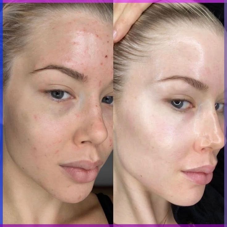 Before and after hyperpigmentation treatment at EliteMD Aesthetics — Clearer tone & texture