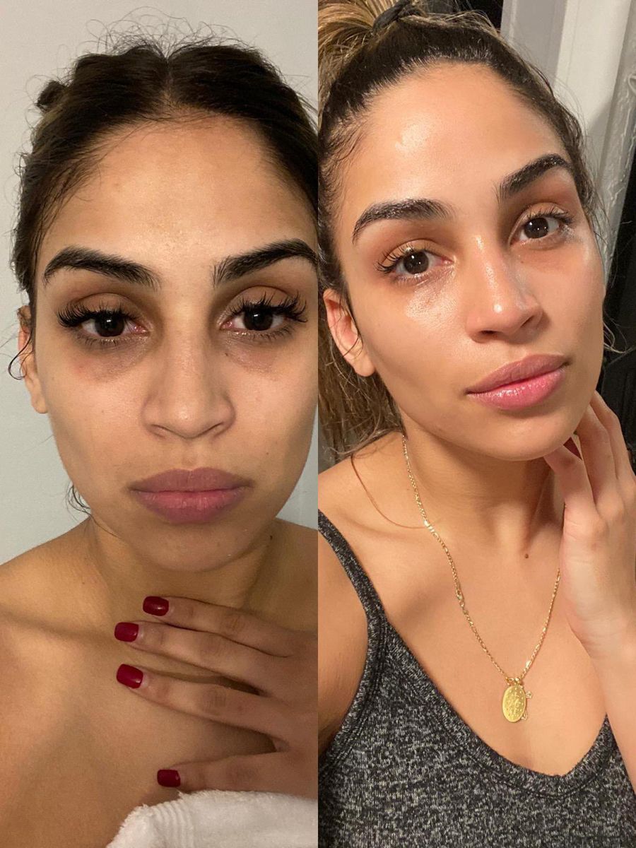Before and after hyperpigmentation treatment at EliteMD Aesthetics — Radiant, balanced skin