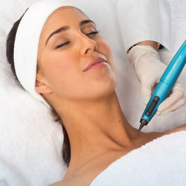 Liquid nitrogen cryotherapy spot removal at EliteMD Aesthetics in Markham