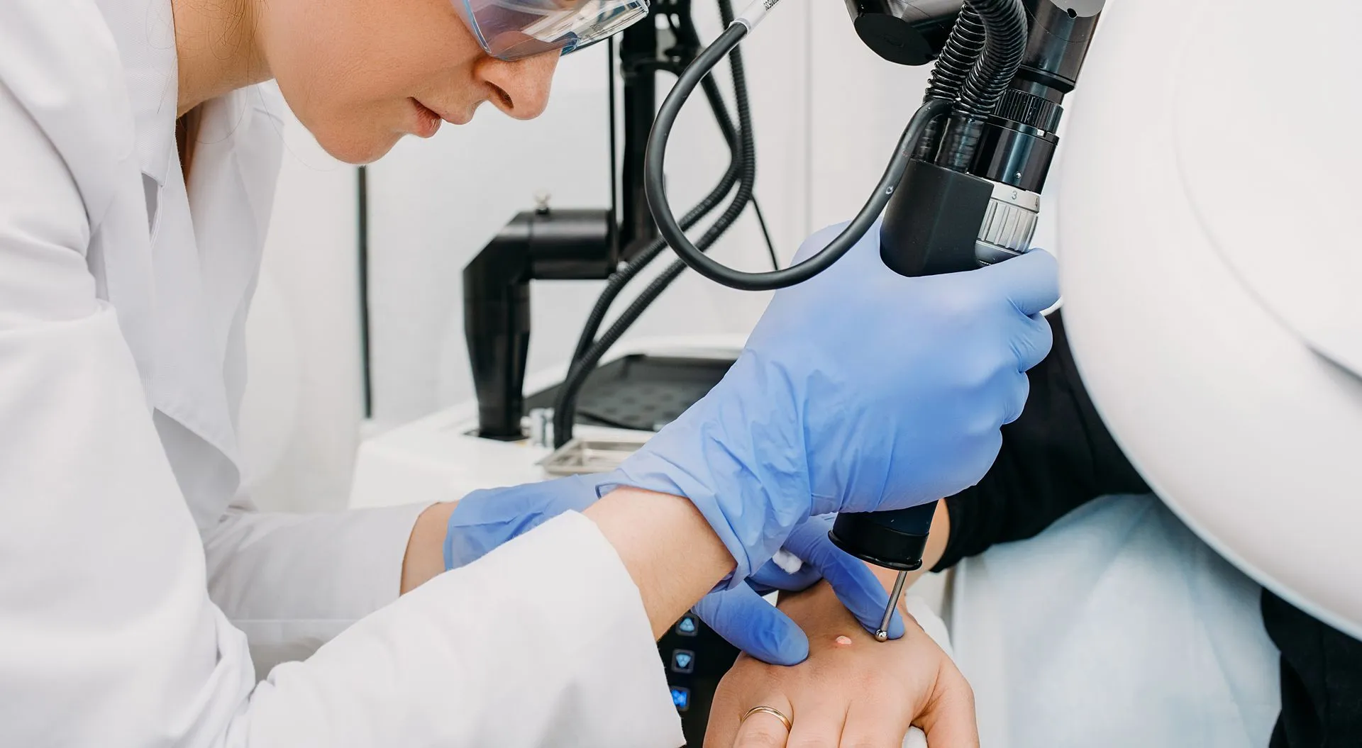 Cryotherapy applied to a benign lesion at EliteMD