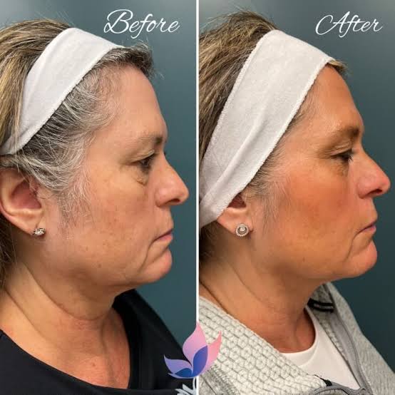 Before and after Morpheus8 — tighter jawline and neck profile