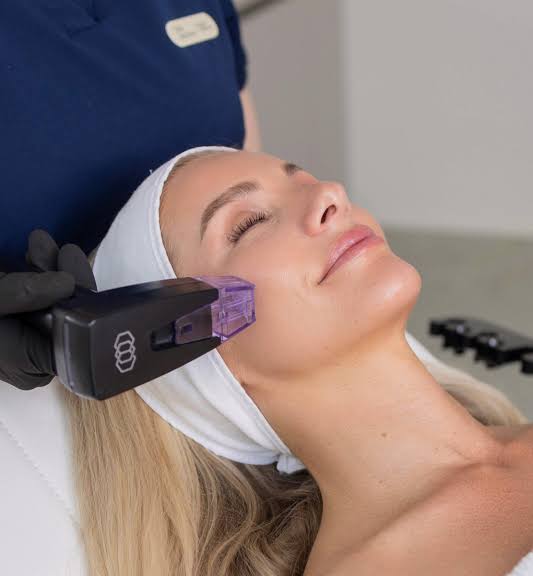 Morpheus8 RF microneedling handpiece treating the cheek at EliteMD Aesthetics in Markham