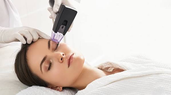 Morpheus8 RF microneedling being performed on the forehead at EliteMD