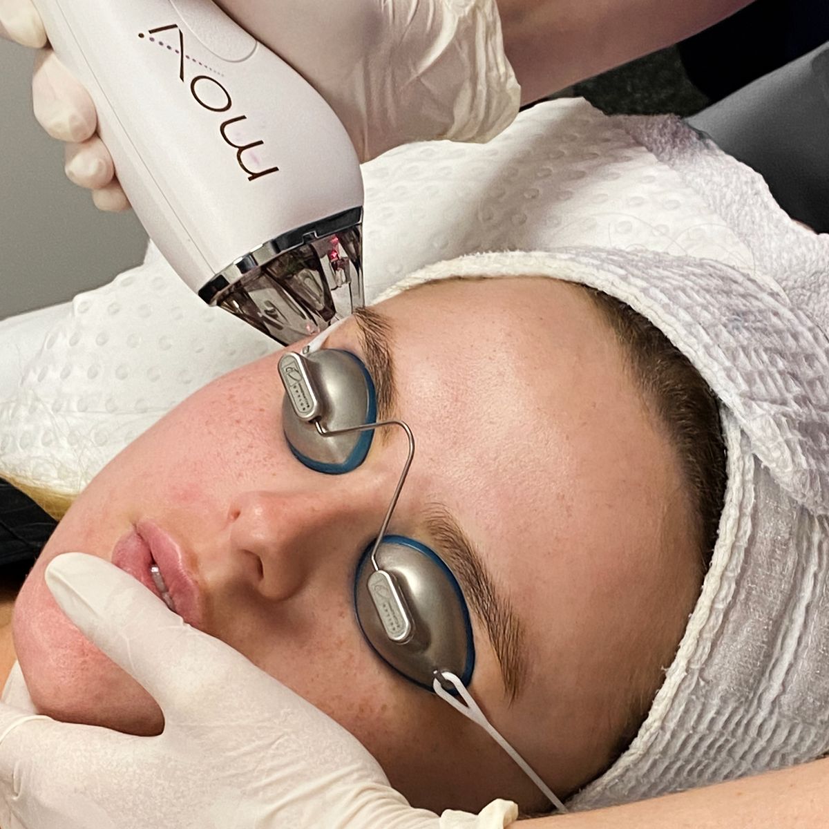 Moxi laser treatment in progress at EliteMD