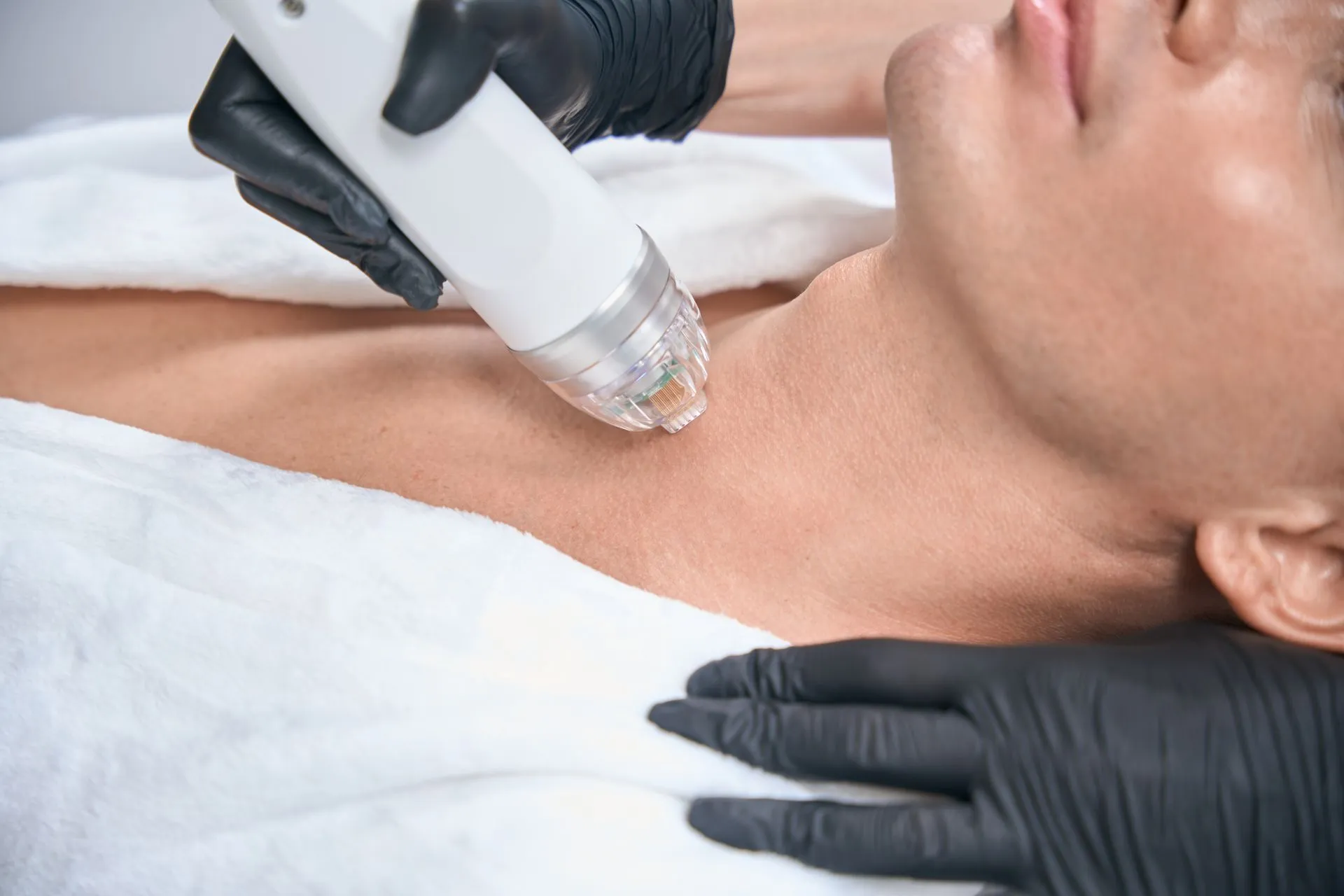 Cynosure Potenza RF microneedling treatment at EliteMD