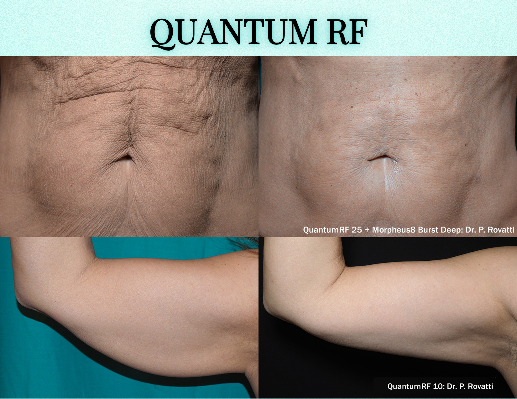 QuantumRF before and after results on the neck and arms