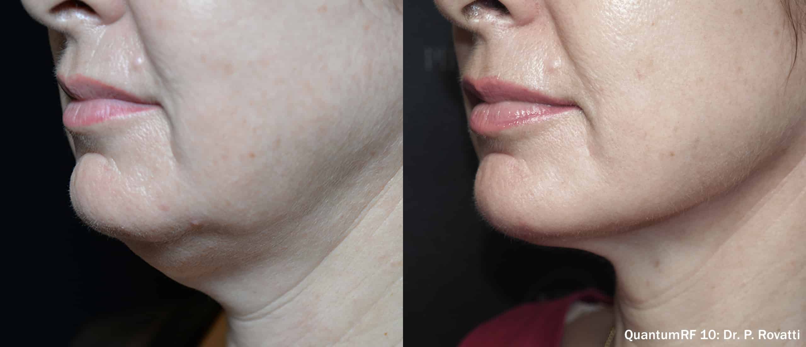 Before and after QuantumRF — tighter jawline and jowls in profile
