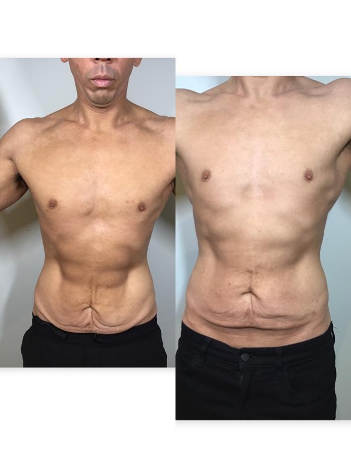 Before and after QuantumRF — firmer abdomen and chest